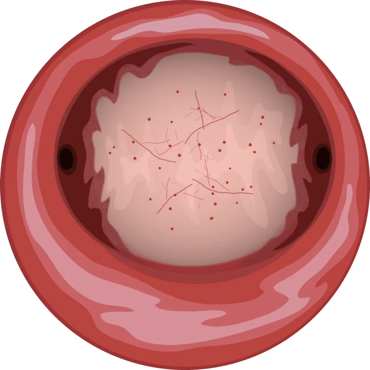 Vue hystéroscopique : endomètre atrophique après la ménopause (illustration)