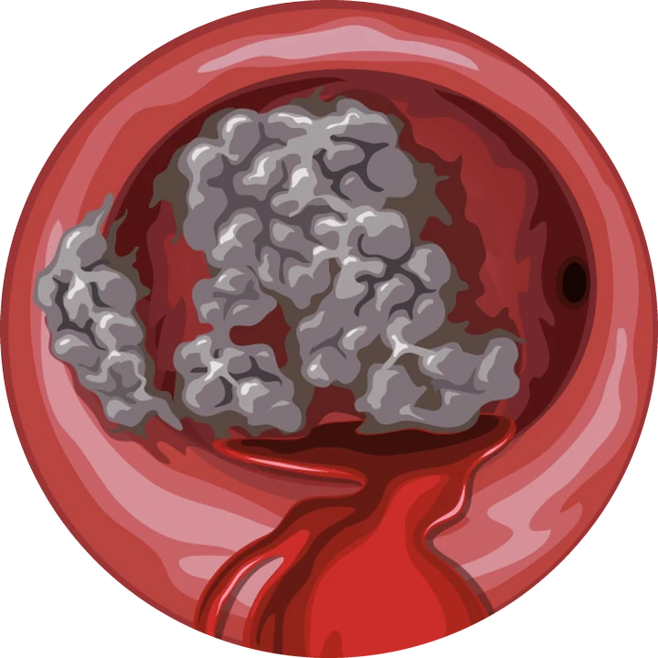 Vue hystéroscopique : lésion suspecte de l'endomètre (illustration)