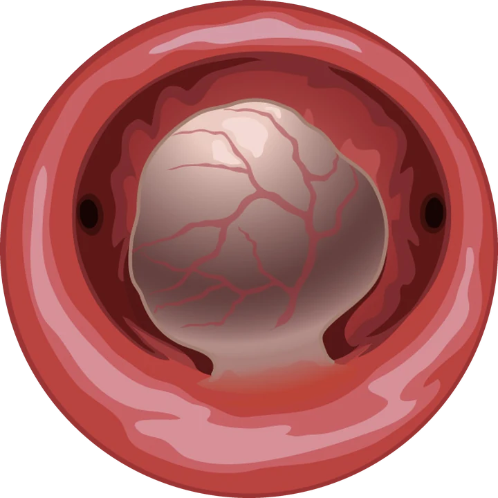 Vue hystéroscopique : fibrome sous-muqueux vascularisé (illustration)
