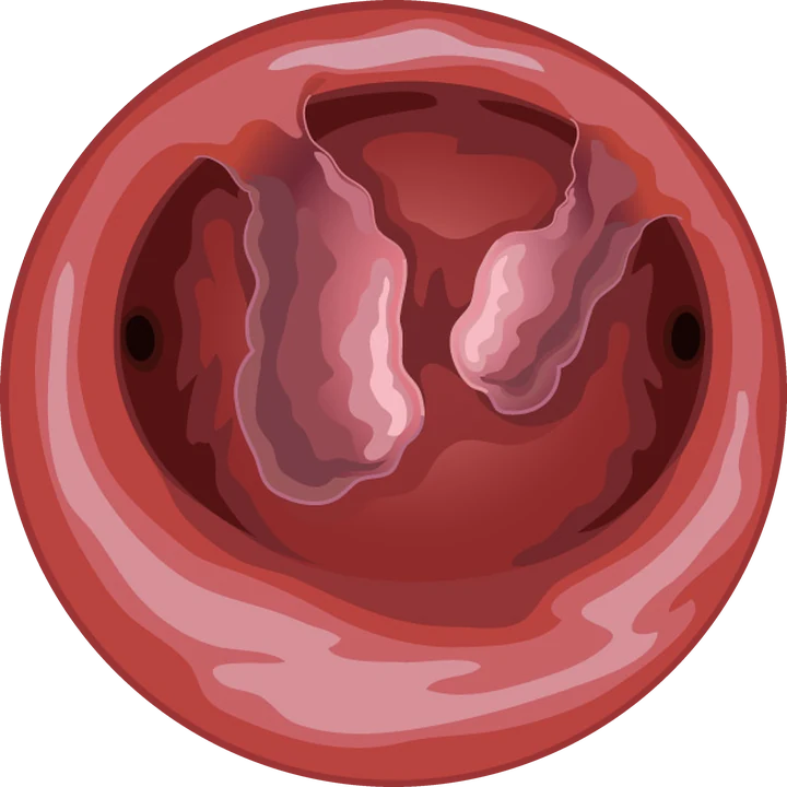 Vue hystéroscopique : polype de l'endomètre (illustration)