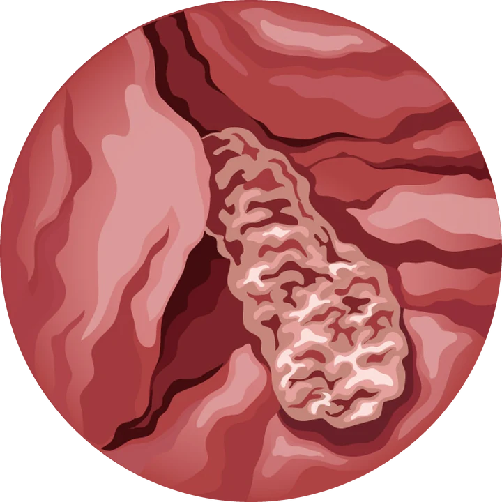 Vue hystéroscopique : rétention de tissu après une grossesse (illustration)