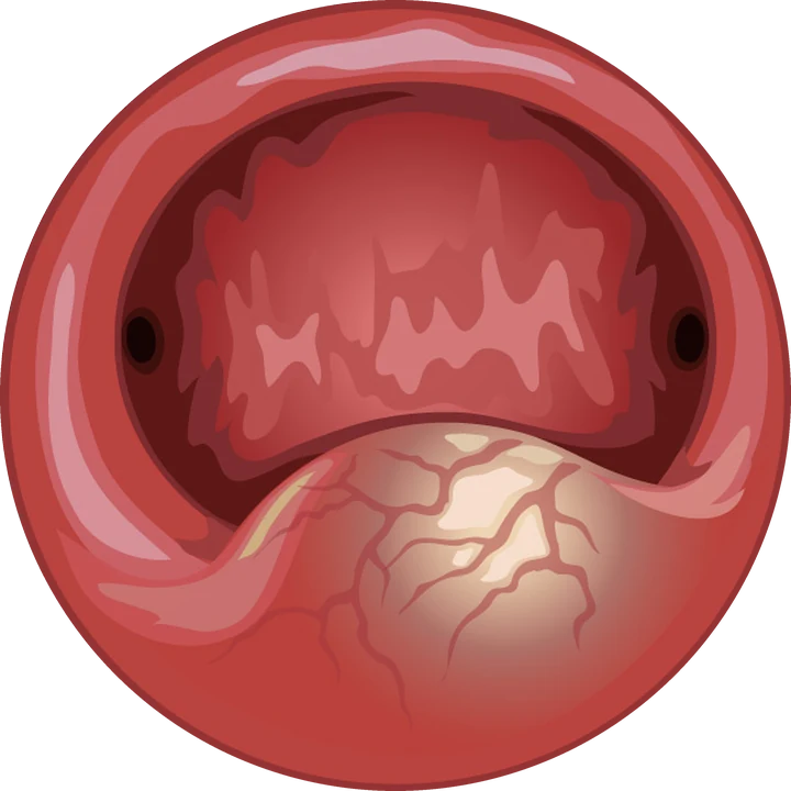 Fibrome sous-muqueux à composante intramurale — Le fibrome bombe dans la cavité tout en restant enchâssé dans le muscle utérin (type 2 FIGO).