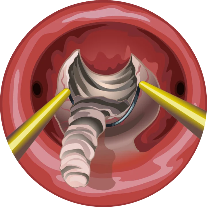 Résection en copeaux — Le fibrome est retiré par fines lamelles successives jusqu'au plan du muscle sain.