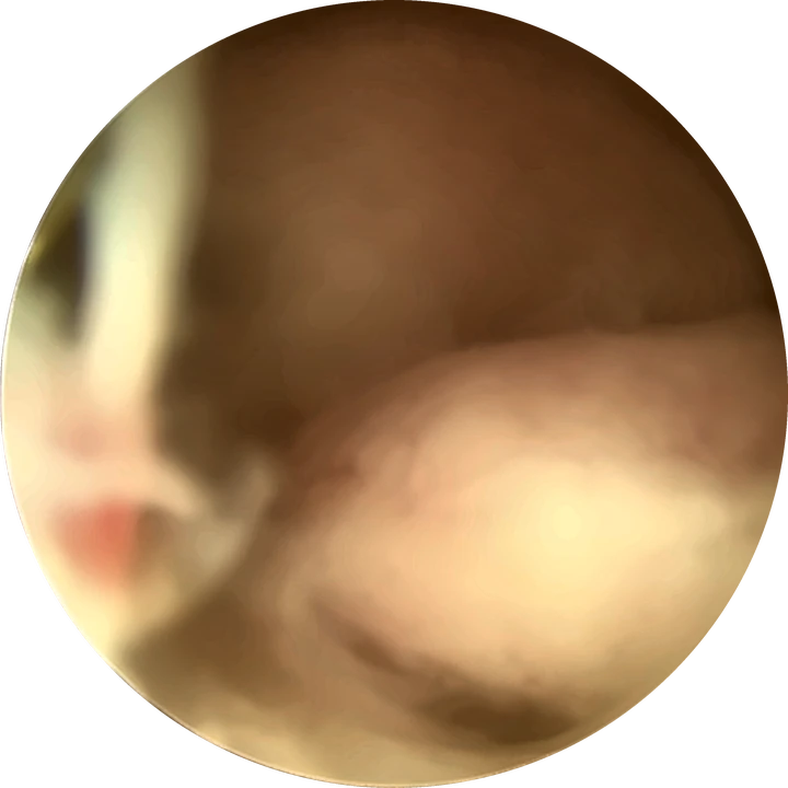 Fibrome sous-muqueux — Voussure lisse, blanc-jaunâtre, parcourue de fins vaisseaux, qui déforme la cavité.