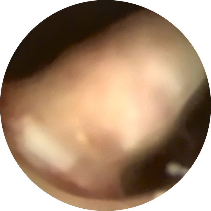 Polype de l'endomètre — Formation allongée, lisse et molle, qui flotte dans le sérum de distension.