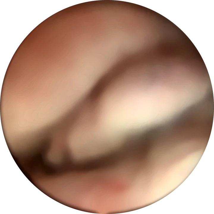 Polype vu de profil — Relief allongé appendu à la paroi, séparé de celle-ci par un sillon.