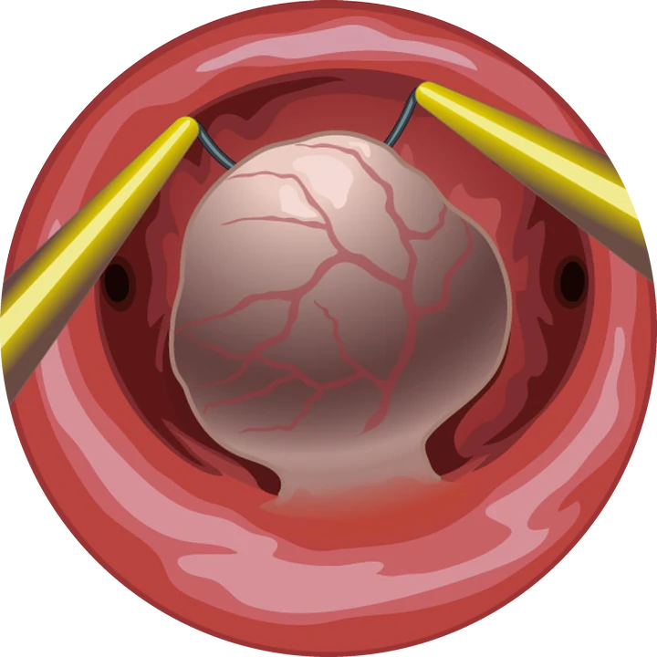 Résection d'un fibrome pédiculé — L'anse du résecteur aborde le fibrome (type 0) au ras de son pied d'implantation.