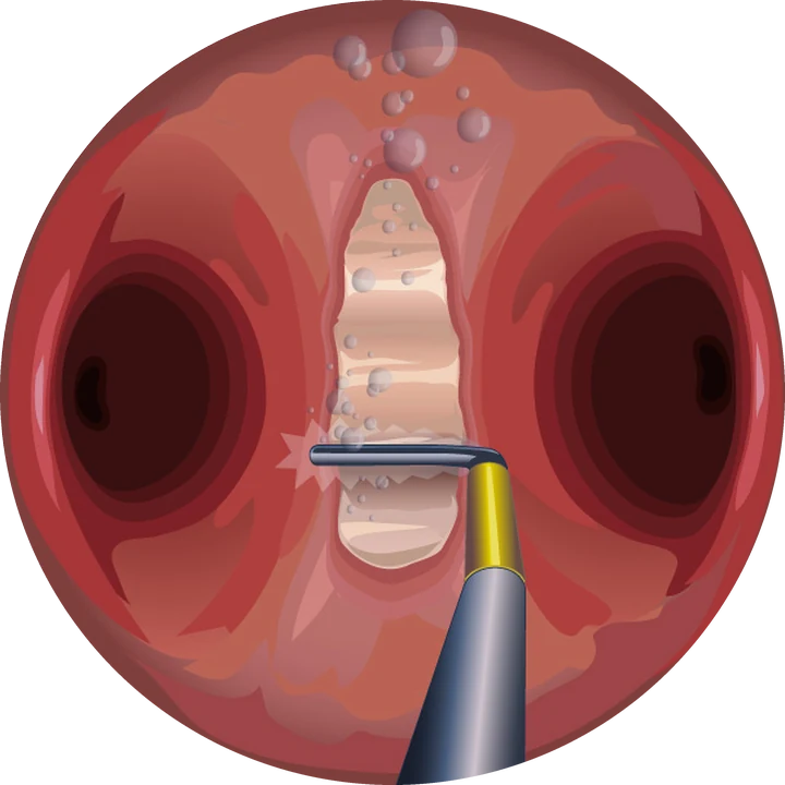 Section d'une cloison utérine — La cloison est incisée sur la ligne médiane, du bas vers le fond, jusqu'à retrouver une cavité unique.